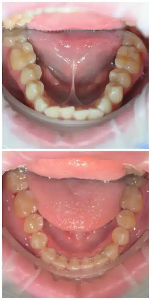 Orthodontics Aligners Before And After